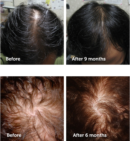 How Effective is Platelet Rich Plasma (PRP) for Hair Restoration? | Doctor  Kedy Jao
