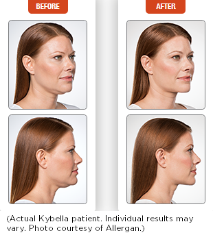 Kybella before and after 1